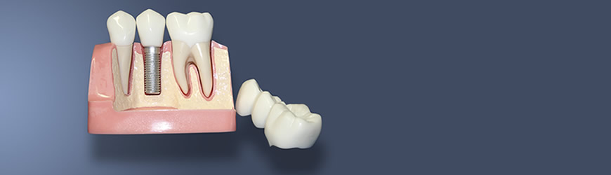 İzmirli Ortodonti - Mini İmplantlar